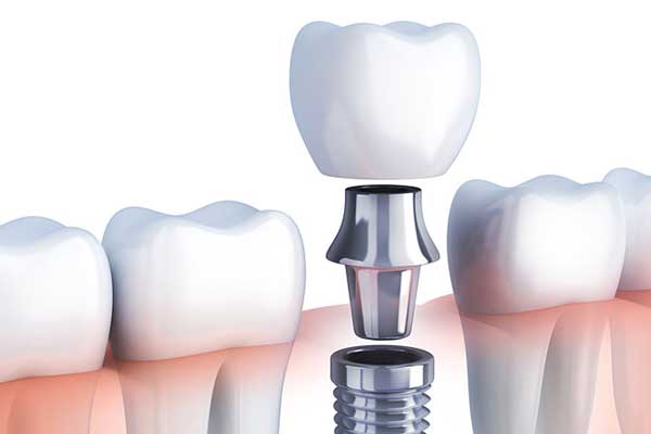 clinicas implantes dentales zaragoza